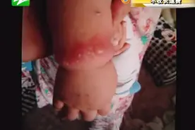 孩子手腕起泡，怀疑腕带过敏视频封面