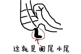 这个痛得遭不住的急性阑尾炎，不管你娃儿几岁都可能会得！图片