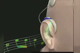 医学3D动画演示：人工耳蜗的工作原理视频封面