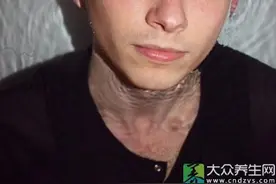 导致干燥综合症的三大病因图片
