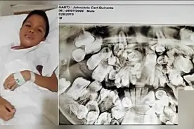 男孩患多齿症长300颗牙齿