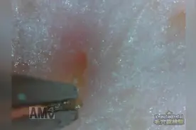 200倍镜头下拔黑头，一个接一个，看完真是太爽了！图片