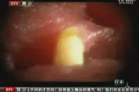 慎入！没事别乱跑，实拍旅游感染的寄生虫拔出过程。图片