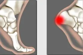 跟腱炎如何进行自我按摩治疗图片