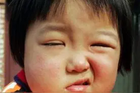 亲妈一巴掌把女儿打成面瘫 科普后愣傻了图片