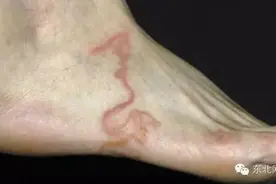 旅游回来发现脚上长了奇怪的东西，居然是寄生虫图片