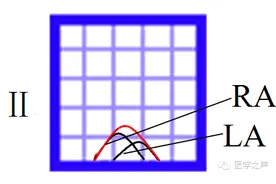 心电图课堂|第3期：右房肥大与双房肥大图片