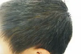 少白头遗传的几率有多大？多半由父母亲哪一方遗传？视频封面