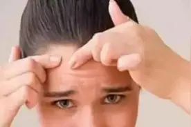 教你正确的挤痘姿势！2分钟就能get一个新技能！图片