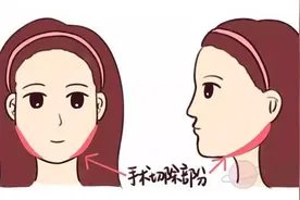 瘦脸针的真相！小心整容变毁容，再不知道就晚啦！图片