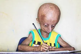 少年14岁患早衰症，老去的速度是同龄人8倍极少数活过20岁。图片