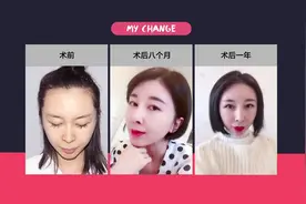 女星们发际线下移1cm就能回春，植发有这么神奇吗？视频封面