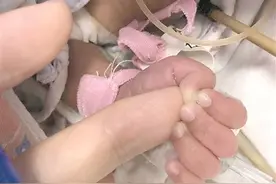 手术中，早产宝宝突然抓住医生手指图片