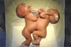 湖南首例存活的连体双胞胎9岁了 妹妹要做眼睑下垂修复术图片