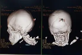 熊孩子甩飞刀扎入女童脑袋 刀上刻“小李飞刀”图片