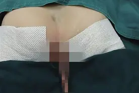 惊呆了！婴儿出生时“长尾巴” 11个月长到15厘米图片