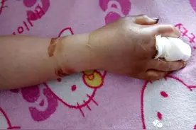 哈尔滨女子山上挖野菜 不慎被蛇咬伤 整个手掌迅速发生变化图片