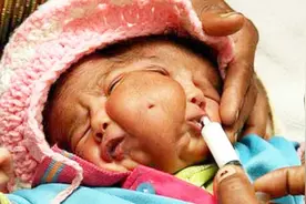 印度双面女婴被当成神灵转世，拒绝医生治疗后死亡视频封面