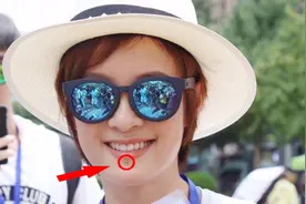 孙俪嘴唇下面的痣因车祸而来？越来越大了为何不拿掉？视频封面