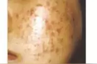 关于粉刺你不知道的那些事儿！图片