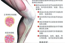 解说横纹肌溶解症图片