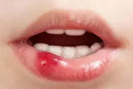 你的嘴角是不是又烂了？上火？没那么简单！图片