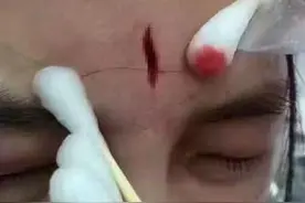 护士扎针未能一次成功 被家长砸伤额头，护士也是别人家的孩子啊图片