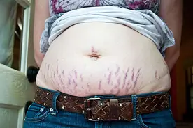 肥胖纹和妊娠纹好难看，该怎么去除？图片