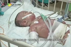 女婴掉进热锅里 沸水烫伤治疗“难”