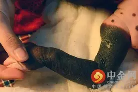 女婴患巨型兽皮痣图片