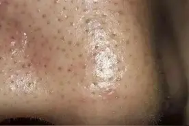 关于安全去黑头的三要四不要。你肯定不知道！图片