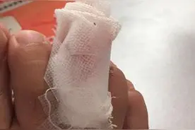 没有脚趾甲的脚还能正常走路吗图片