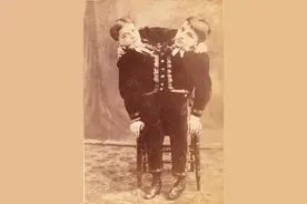 盘点历史上最不可思议的连体双胞胎图片