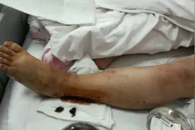 各种运动中可怕骨折瞬间，看了身上冒汗的视频视频封面