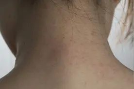 脖子刮痧的好处和坏处图片