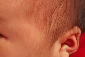 宝宝头上起好多小红点，有经验的宝妈帮帮忙图片