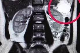 女子孕3月子宫却没胎儿，超声检查发现发现宝宝长在这！图片