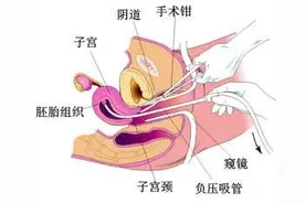 无痛人流是怎么进行的图片