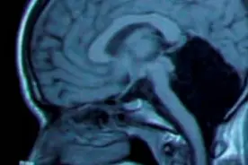 世界无奇不有：没有小脑竟然能正常生活 ！图片