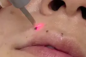 激光祛痣，大于2mm的痣建议手术切除#皮肤健康科普#视频封面
