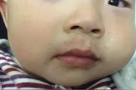 女孩长出红色“胡子”，不是激素引起而是因为一个小动作图片