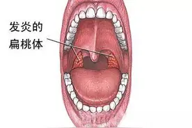 专家讲堂扁桃体炎的危害有哪些图片