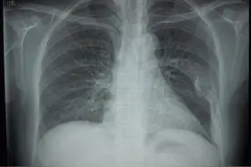 E诊断：骨纤维异常增殖症图片