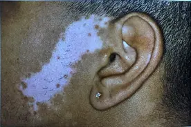 患了白癜风，该如何面对治不好的人生和未来?图片