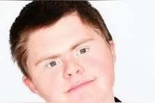 唐氏综合征的面容能改变？！图片