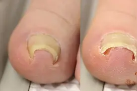 脚指甲卷曲到肉里，不用拔的处理方法视频封面