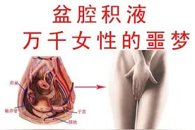 盆腔积液“真假”如何辨别图片