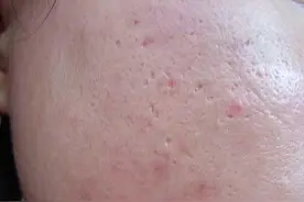 目前有效解决痘坑只有这四种方法图片