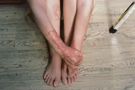 被官二代泼汽油周岩女孩直面伤疤依旧相信爱情图片