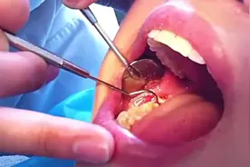 好恐怖！实拍美女拔牙全过程！